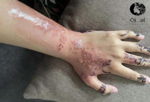 أضرار الحناء