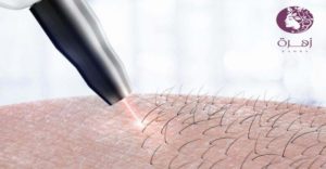 إزالة الشعر بالليزر | أهم 9 نصائح لإزالة الشعر بالليزر
